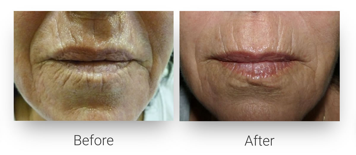 Peri-Oral Wrinkles Reduction