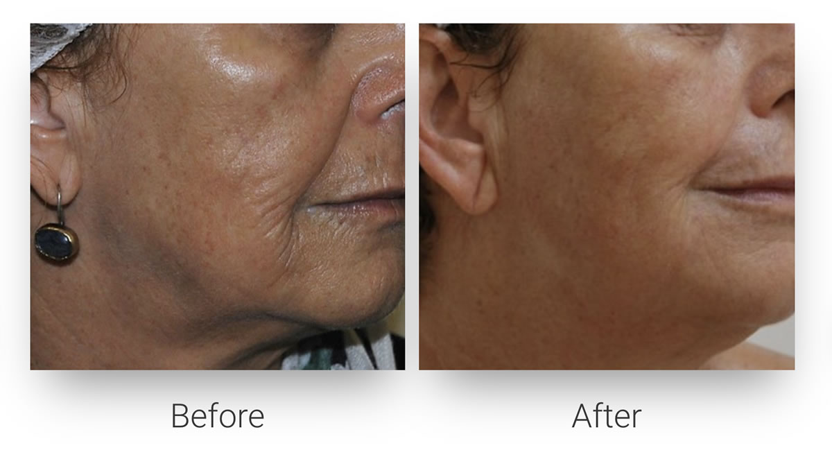 Peri-Oral Wrinkles Reduction
