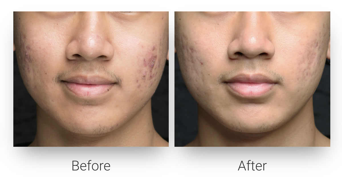 Post-Acne Scar Reduction