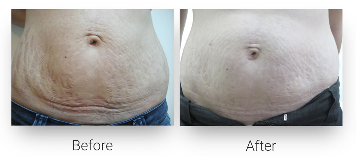 Stretch Mark - Scars Reduction